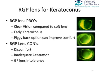 Procornea Rgp Medically Necessary Contact Lenses for Irregular Cornea | PDF