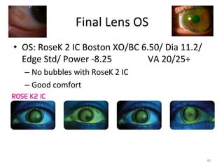 Medically Necessary Contact Lenses for Irregular Cornea | PDF
