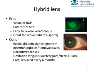 Consin Rgp Medically Necessary Contact Lenses for Irregular Cornea | PDF