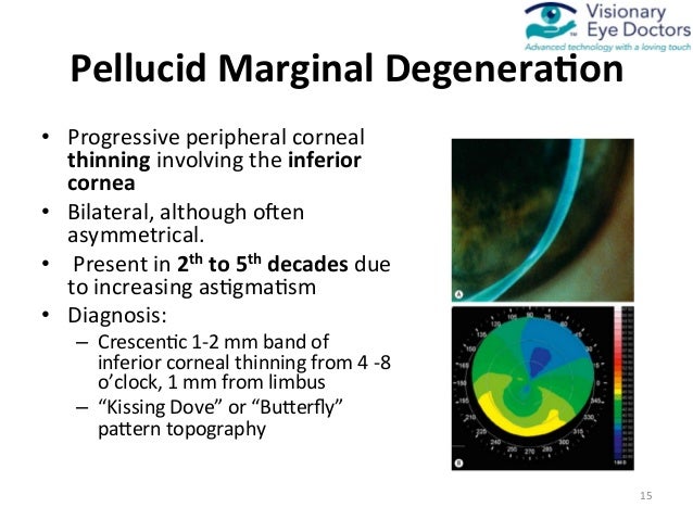 Medically Necessary Contact Lenses for Irregular Cornea