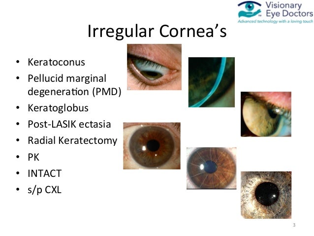 Medically Necessary Contact Lenses for Irregular Cornea