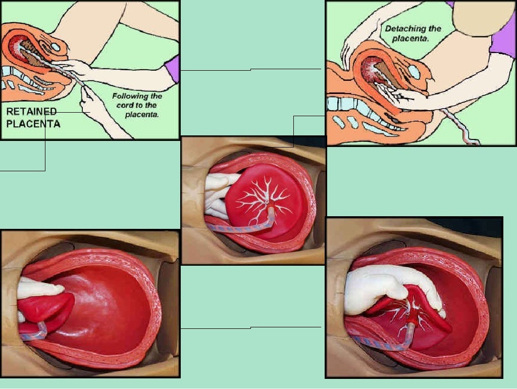 medical-management-of-postpartum-hemorrhage-pph-lecture