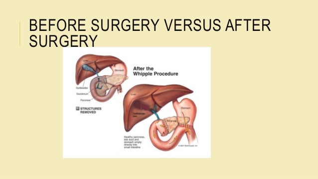 Medical nutrition therapy status post whipple procedure