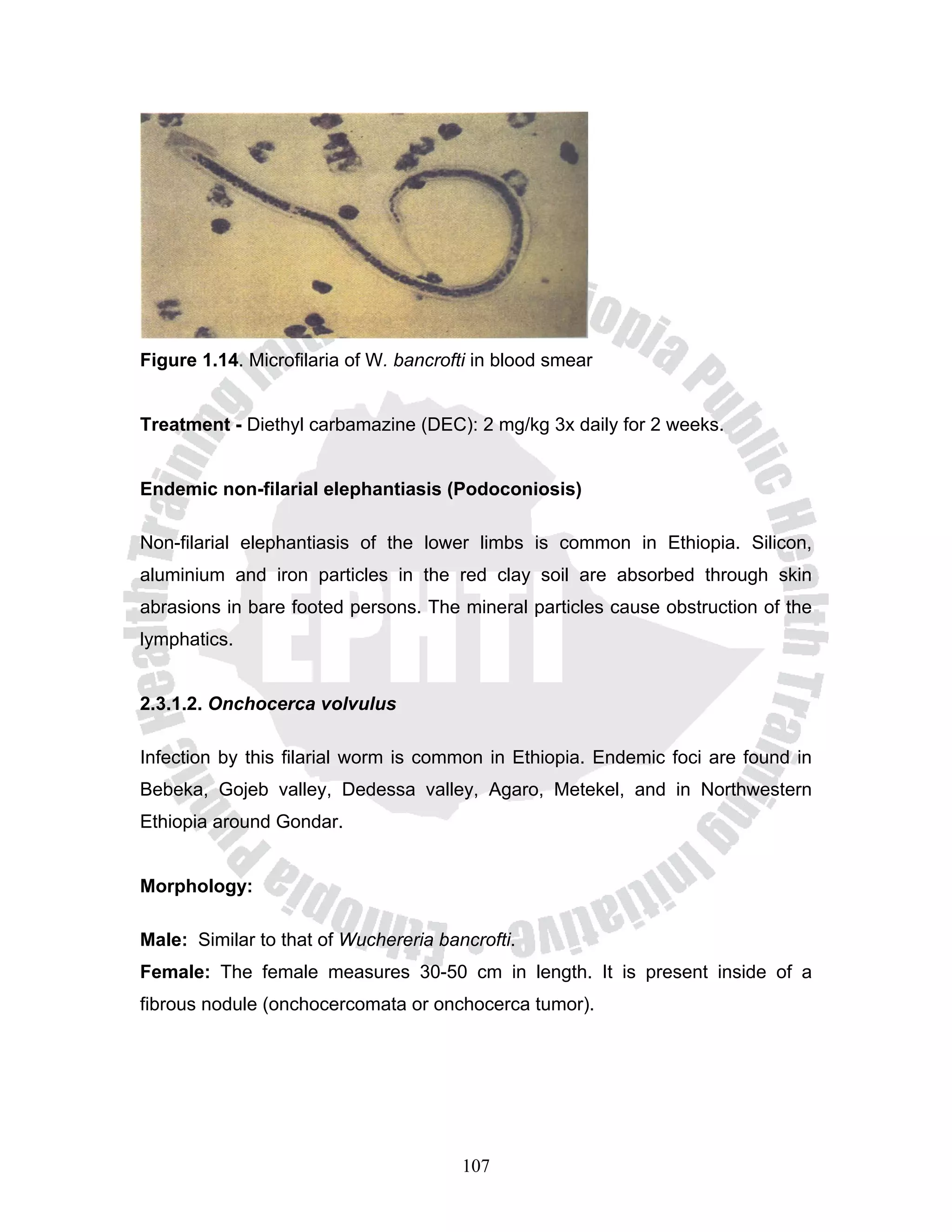 Figure 1.14. Microfilaria of W. bancrofti in blood smear


Treatment - Diethyl carbamazine (DEC): 2 mg/kg 3x daily for 2 weeks.


Endemic non-filarial elephantiasis (Podoconiosis)

Non-filarial elephantiasis of the lower limbs is common in Ethiopia. Silicon,
aluminium and iron particles in the red clay soil are absorbed through skin
abrasions in bare footed persons. The mineral particles cause obstruction of the
lymphatics.


2.3.1.2. Onchocerca volvulus

Infection by this filarial worm is common in Ethiopia. Endemic foci are found in
Bebeka, Gojeb valley, Dedessa valley, Agaro, Metekel, and in Northwestern
Ethiopia around Gondar.


Morphology:

Male: Similar to that of Wuchereria bancrofti.
Female: The female measures 30-50 cm in length. It is present inside of a
fibrous nodule (onchocercomata or onchocerca tumor).




                                       107
 