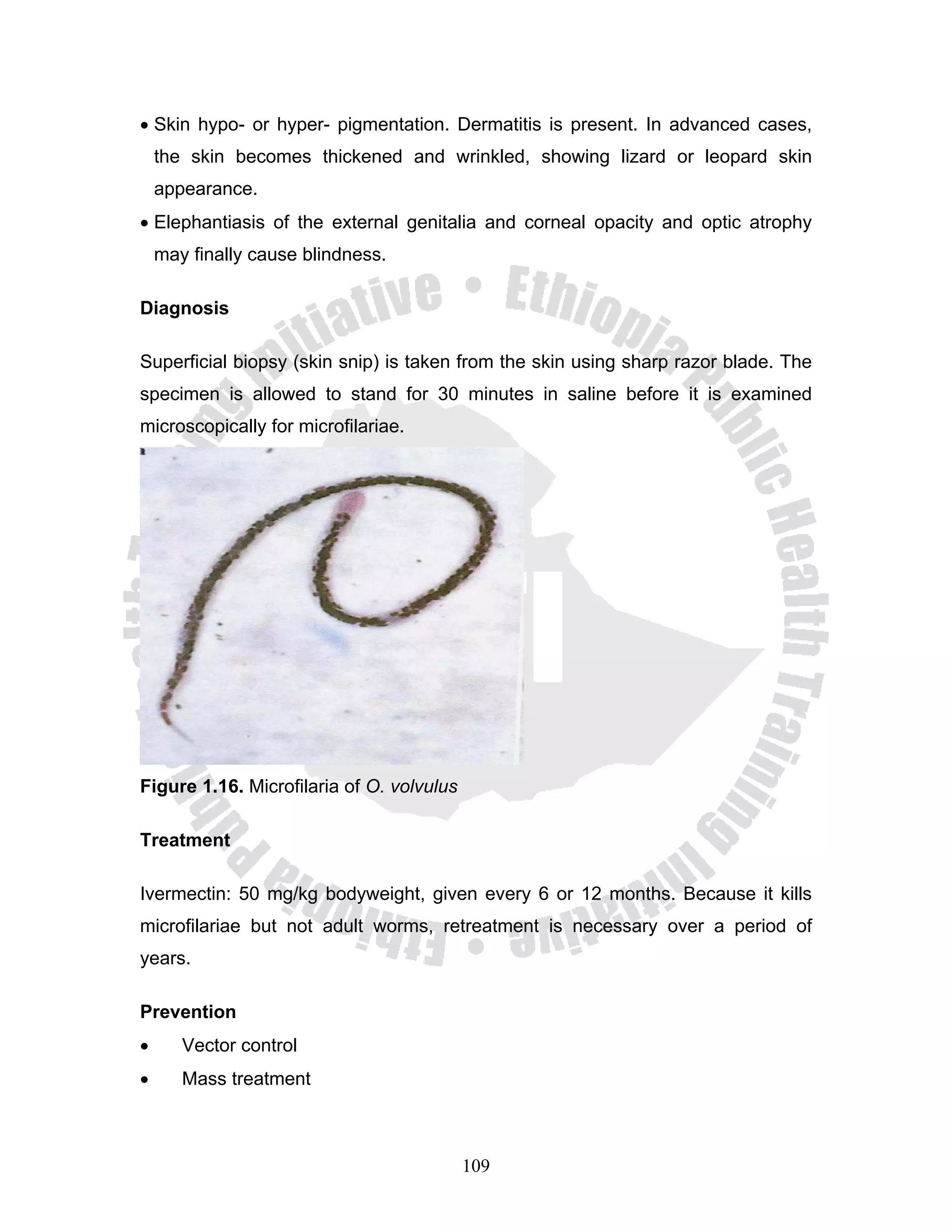 • Skin hypo- or hyper- pigmentation. Dermatitis is present. In advanced cases,
    the skin becomes thickened and wrinkled, showing lizard or leopard skin
    appearance.
• Elephantiasis of the external genitalia and corneal opacity and optic atrophy
    may finally cause blindness.

Diagnosis

Superficial biopsy (skin snip) is taken from the skin using sharp razor blade. The
specimen is allowed to stand for 30 minutes in saline before it is examined
microscopically for microfilariae.




Figure 1.16. Microfilaria of O. volvulus

Treatment

Ivermectin: 50 mg/kg bodyweight, given every 6 or 12 months. Because it kills
microfilariae but not adult worms, retreatment is necessary over a period of
years.

Prevention
•      Vector control
•      Mass treatment



                                           109
 