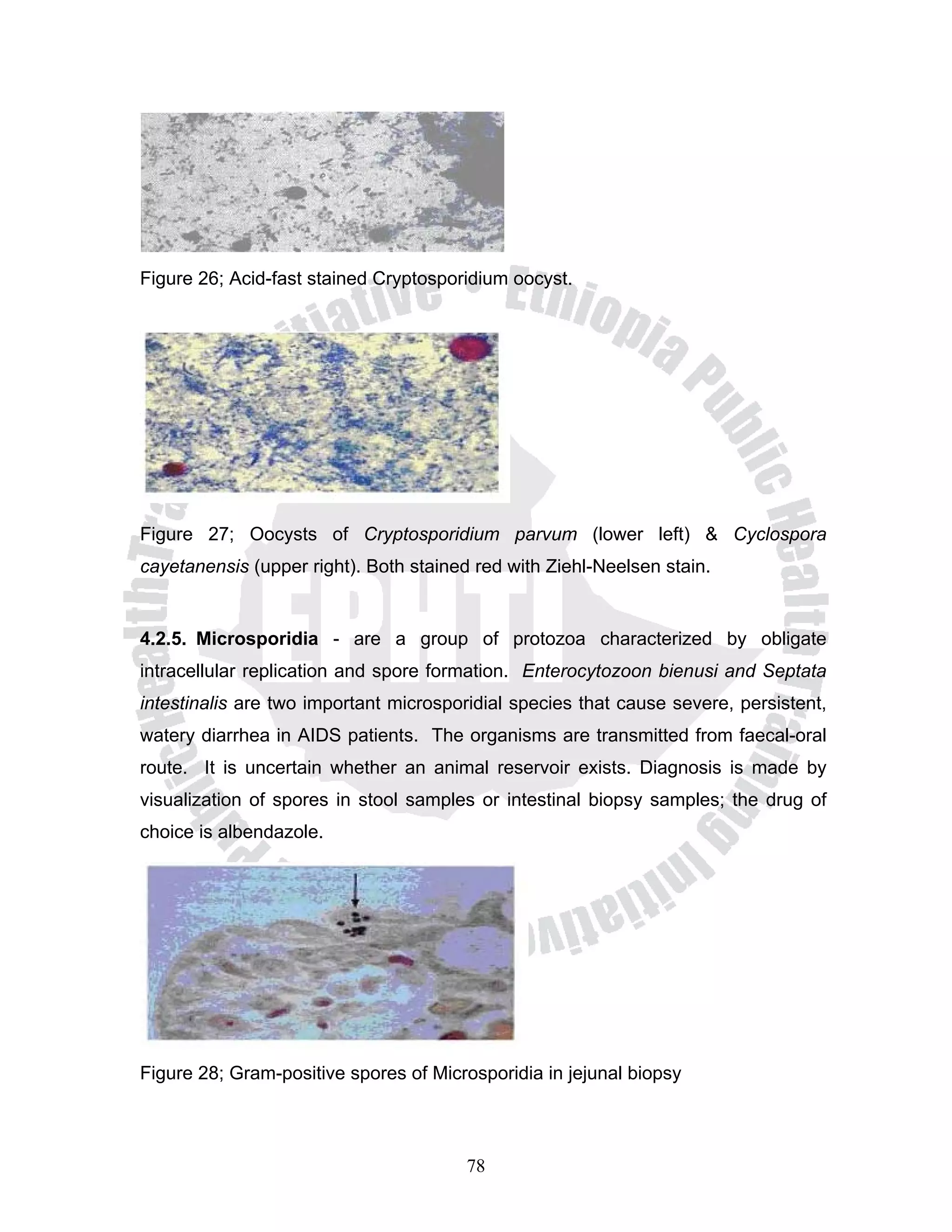 Figure 26; Acid-fast stained Cryptosporidium oocyst.




Figure 27; Oocysts of Cryptosporidium parvum (lower left) & Cyclospora
cayetanensis (upper right). Both stained red with Ziehl-Neelsen stain.


4.2.5. Microsporidia - are a group of protozoa characterized by obligate
intracellular replication and spore formation. Enterocytozoon bienusi and Septata
intestinalis are two important microsporidial species that cause severe, persistent,
watery diarrhea in AIDS patients. The organisms are transmitted from faecal-oral
route. It is uncertain whether an animal reservoir exists. Diagnosis is made by
visualization of spores in stool samples or intestinal biopsy samples; the drug of
choice is albendazole.




Figure 28; Gram-positive spores of Microsporidia in jejunal biopsy



                                        78
 