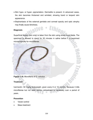 • Skin hypo- or hyper- pigmentation. Dermatitis is present. In advanced cases,
    the skin becomes thickened and wrinkled, showing lizard or leopard skin
    appearance.
• Elephantiasis of the external genitalia and corneal opacity and optic atrophy
    may finally cause blindness.

Diagnosis

Superficial biopsy (skin snip) is taken from the skin using sharp razor blade. The
specimen is allowed to stand for 30 minutes in saline before it is examined
microscopically for microfilariae.




Figure 1.16. Microfilaria of O. volvulus

Treatment

Ivermectin: 50 mg/kg bodyweight, given every 6 or 12 months. Because it kills
microfilariae but not adult worms, retreatment is necessary over a period of
years.

Prevention
•      Vector control
•      Mass treatment



                                           109
 