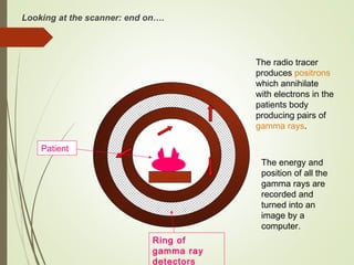 Looking at the scanner: end on….
Ring of
gamma ray
detectors
Patient
The radio tracer
produces positrons
which annihilate
with electrons in the
patients body
producing pairs of
gamma rays.
The energy and
position of all the
gamma rays are
recorded and
turned into an
image by a
computer.
 