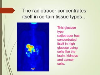 The radiotracer concentrates
itself in certain tissue types…
This glucose
type
radiotracer has
concentrated
itself in high
glucose using
cells like the
brain, kidneys
and cancer
cells.
 