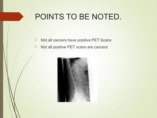 POINTS TO BE NOTED.
 Not all cancers have positive PET Scans
 Not all positive PET scans are cancers
 