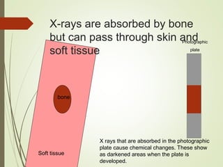 X-rays are absorbed by bone
but can pass through skin and
soft tissue
bone
Soft tissue
Photographic
plate
X rays that are absorbed in the photographic
plate cause chemical changes. These show
as darkened areas when the plate is
developed.
 