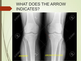 WHAT DOES THE ARROW
INDICATES?
ANSWER: GROWTH PLATES.
 