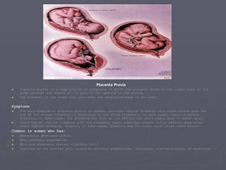 Placenta Previa Placenta previa is a complication of pregnancy in which the placenta grows in the lowest part of the womb (uterus) and covers all or part of the opening to the cervix. The placenta is the organ that nourishes the developing baby in the womb. Symptoms The main symptom of placenta previa is sudden, painless vaginal bleeding that often occurs near the end of the second trimester or beginning of the third trimester. In some cases, there is severe bleeding, or hemorrhage. The bleeding may stop on its own but can start again days or weeks later. There may be uterine cramping with the bleeding. Labor sometimes starts within several days after heavy vaginal bleeding. However, in some cases, bleeding may not occur until after labor starts. Common in women who has: Abnormally developed uterus Many previous pregnancies Multiple pregnancy (twins, triplets, etc.) Scarring of the uterine wall caused by previous pregnancies, cesareans, uterine surgery, or abortions 