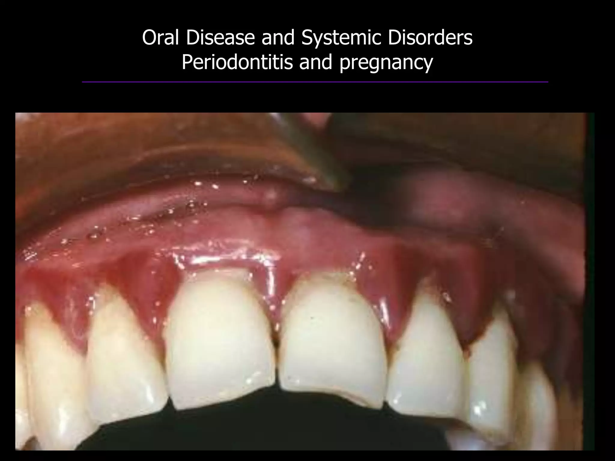 Oral Disease and Systemic Disorders
Periodontitis and pregnancy
 
