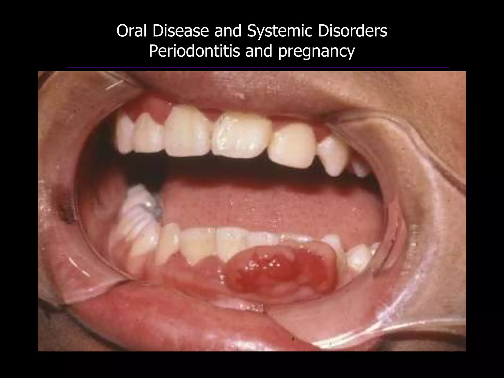 Oral Disease and Systemic Disorders
Periodontitis and pregnancy
 