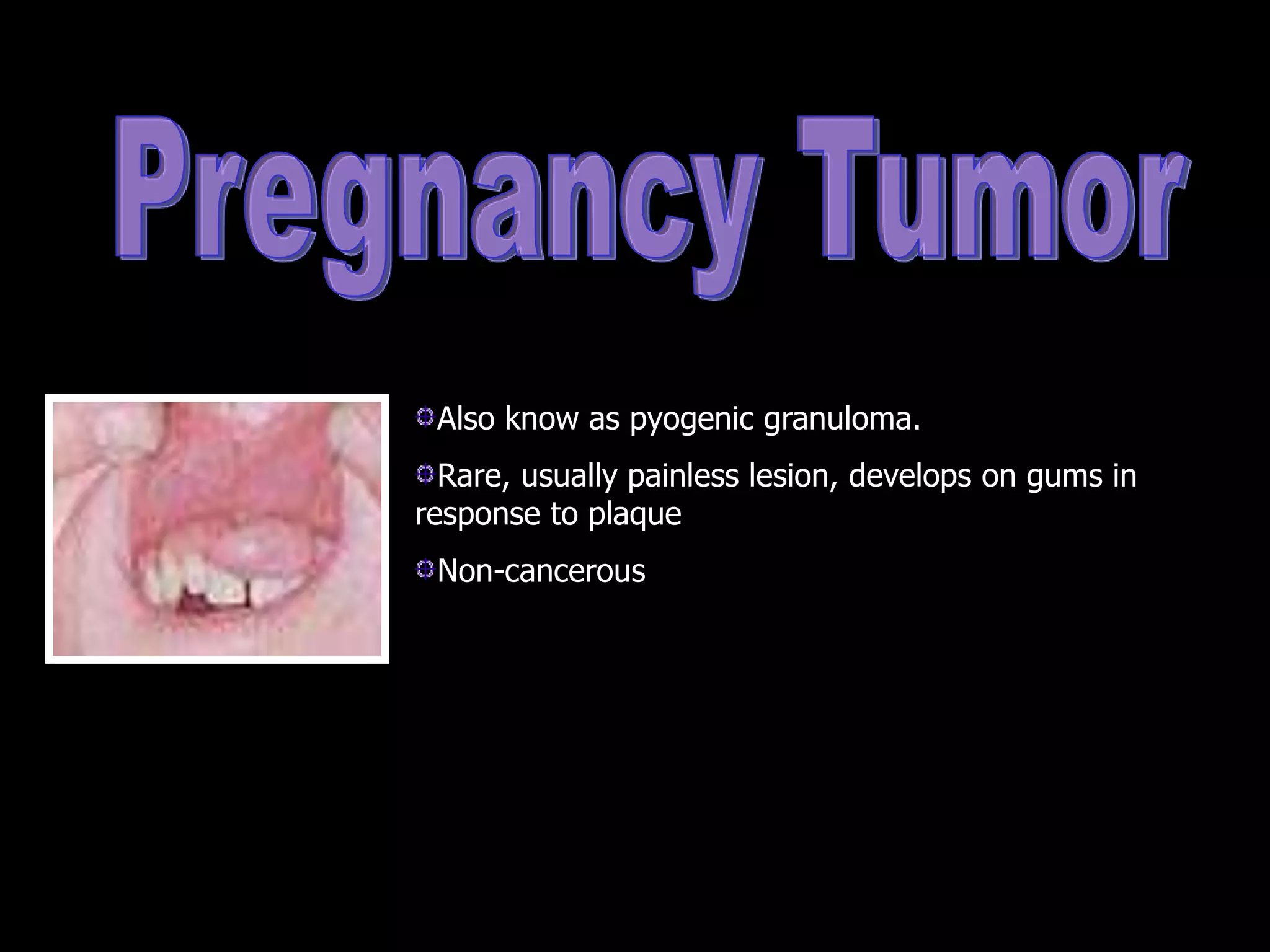 Also know as pyogenic granuloma.
Rare, usually painless lesion, develops on gums in
response to plaque
Non-cancerous
 