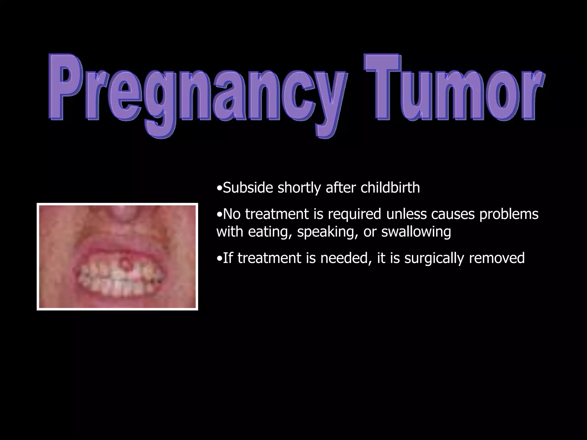 •Subside shortly after childbirth
•No treatment is required unless causes problems
with eating, speaking, or swallowing
•If treatment is needed, it is surgically removed
 
