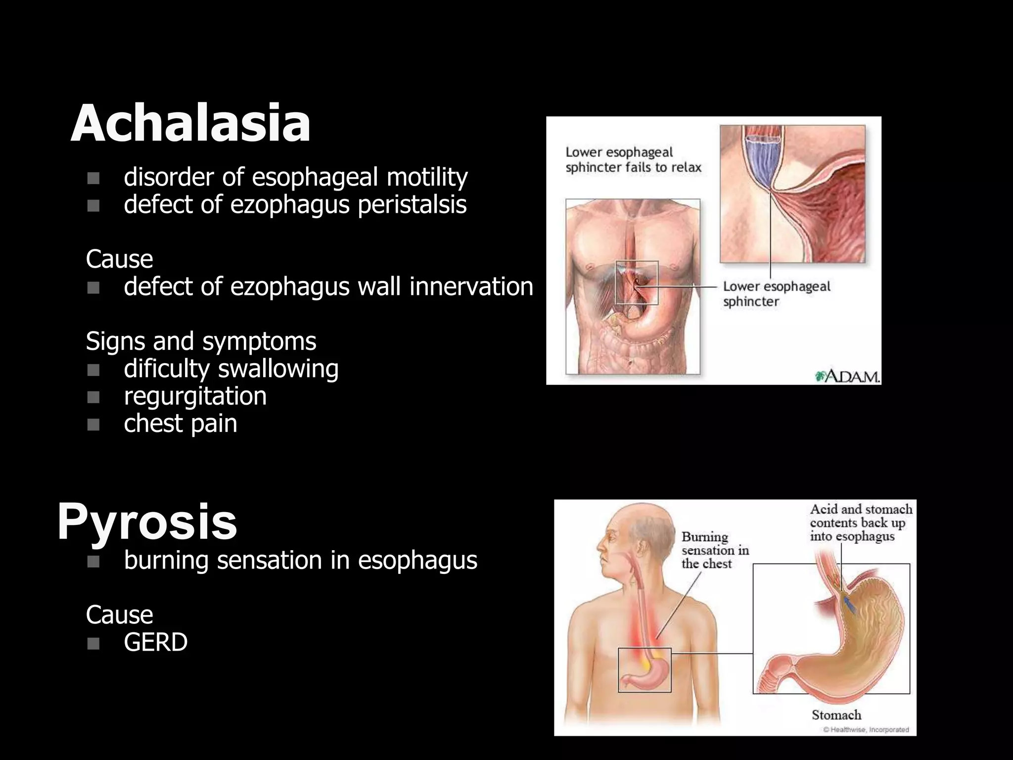 Achalasia
 disorder of esophageal motility
 defect of ezophagus peristalsis
Cause
 defect of ezophagus wall innervation
Signs and symptoms
 dificulty swallowing
 regurgitation
 chest pain
 burning sensation in esophagus
Cause
 GERD
Pyrosis
 