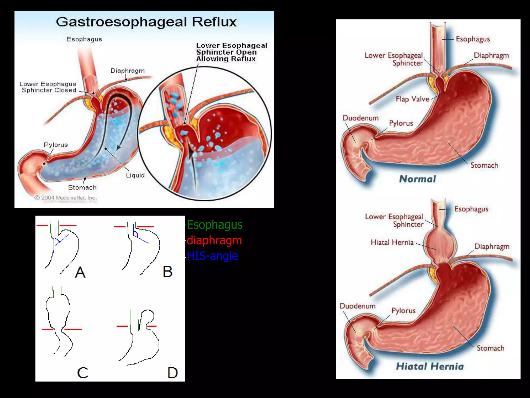 Esophagus
diaphragm
HIS-angle
A - normal anatomy
B – hiatal hernia pre-stage
C - sliding hiatal hernia
D - paraesophageal type
 