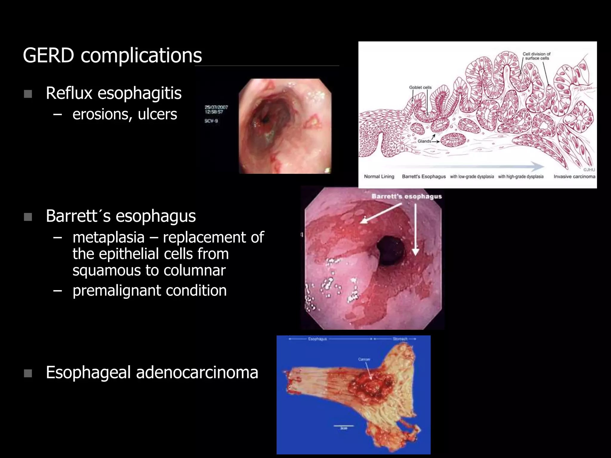 GERD complications
 Reflux esophagitis
– erosions, ulcers
 Barrett´s esophagus
– metaplasia – replacement of
the epithelial cells from
squamous to columnar
– premalignant condition
 Esophageal adenocarcinoma
 