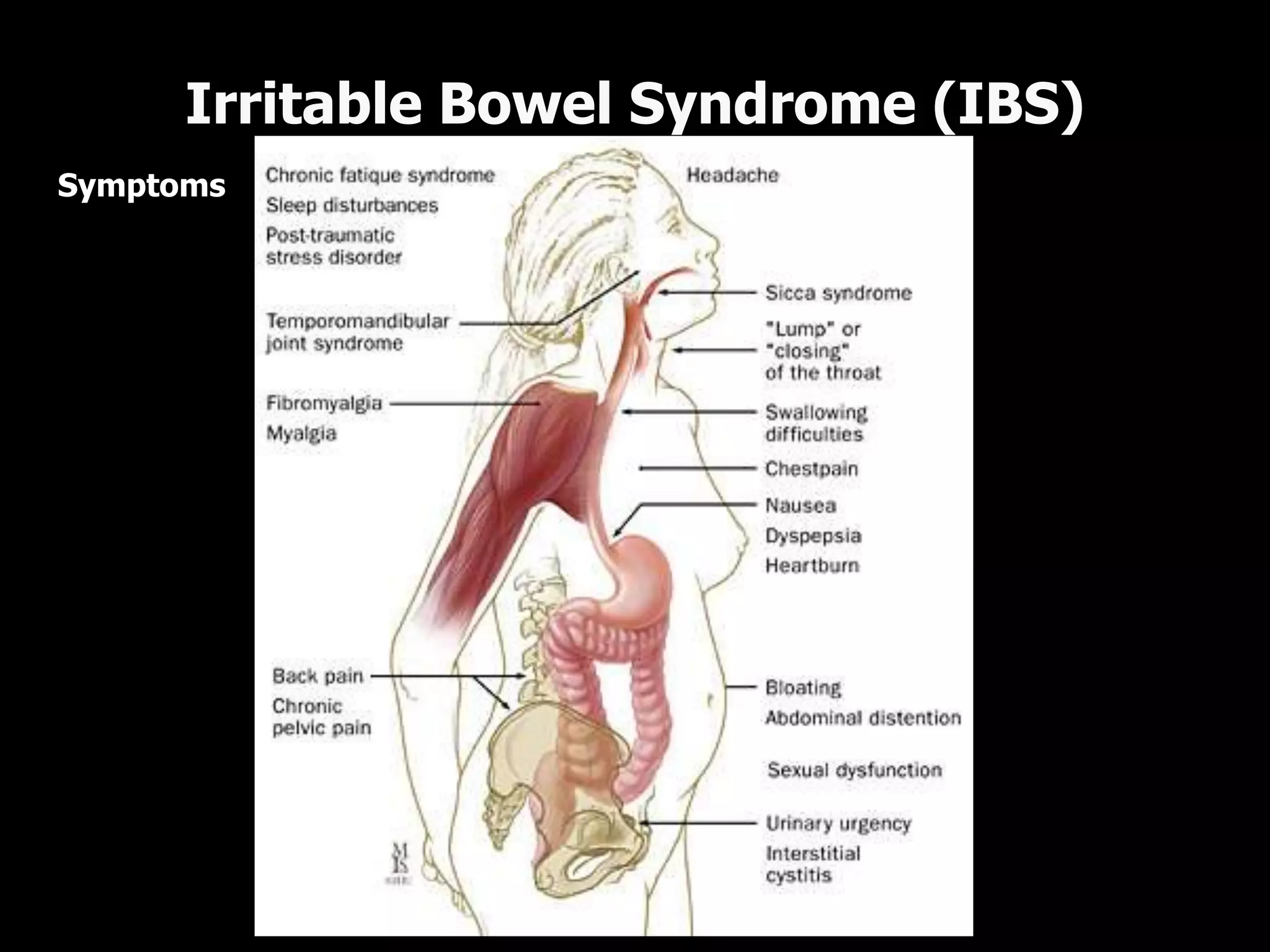 Symptoms
Irritable Bowel Syndrome (IBS)
 