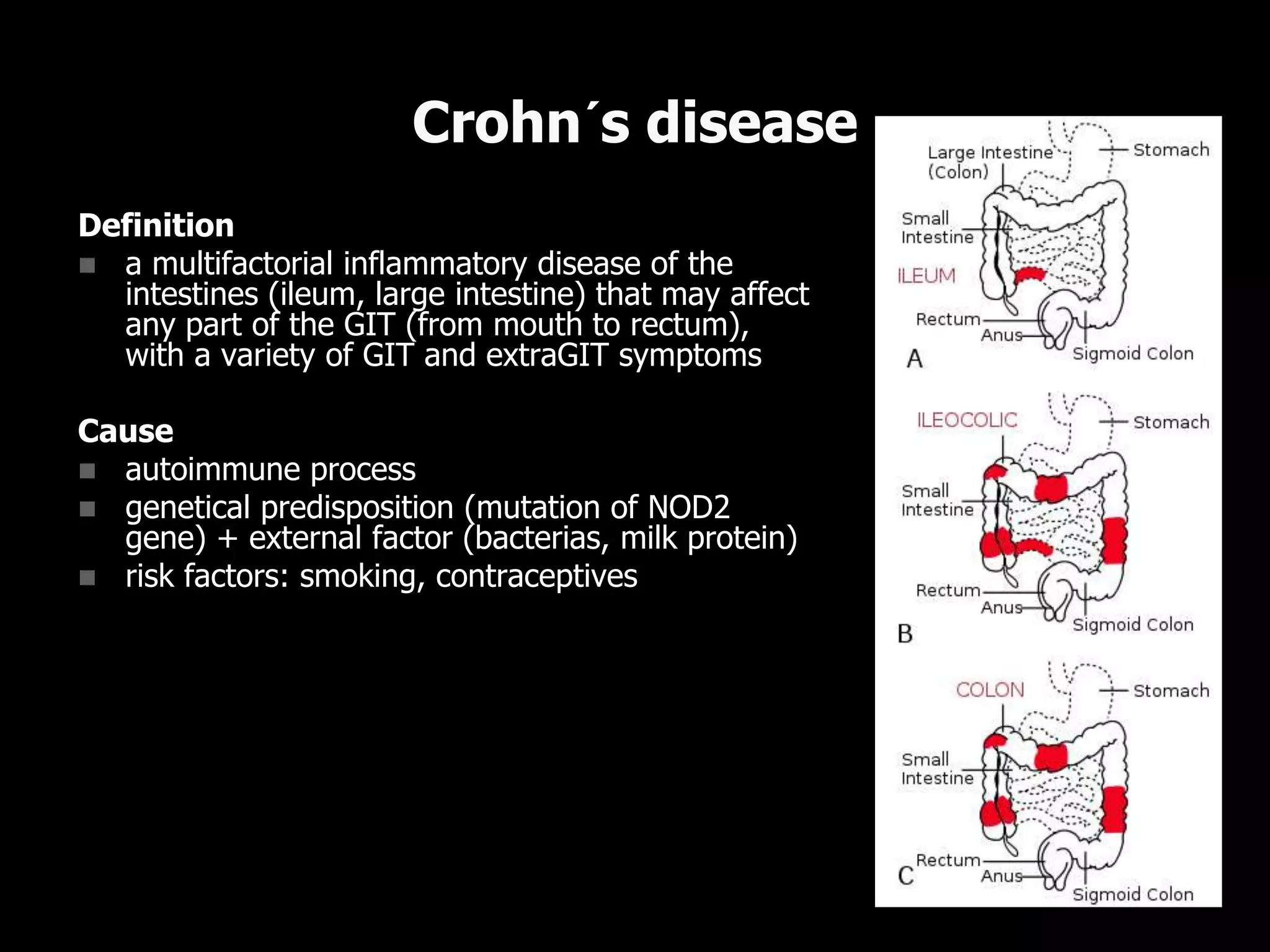 Definition
 a multifactorial inflammatory disease of the
intestines (ileum, large intestine) that may affect
any part of the GIT (from mouth to rectum),
with a variety of GIT and extraGIT symptoms
Cause
 autoimmune process
 genetical predisposition (mutation of NOD2
gene) + external factor (bacterias, milk protein)
 risk factors: smoking, contraceptives
Crohn´s disease
 