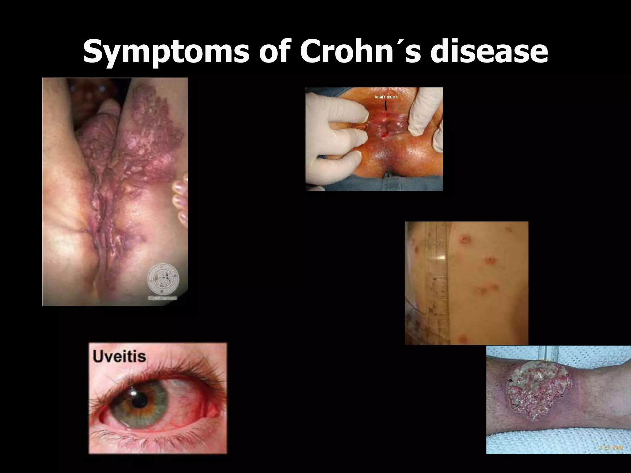 perianal fistulas perianal fissura
erythema nodosum
pyoderma gangrenosum
uveitis
Symptoms of Crohn´s disease
 