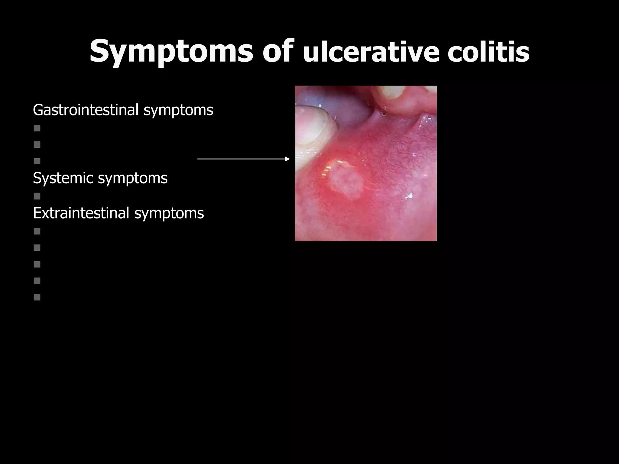 Gastrointestinal symptoms
 diarrhea with blood or mucus
 abdominal pain, cramps
 mouth aphtous ulcers
Systemic symptoms
 loss of apetite, wight loss
Extraintestinal symptoms
 joints – arthritis
 eye - uveitis
 skin - erythema nodosum, pyoderma gangrenosum
 liver – pericholangitis, fatty liver
 blood – hemolytic anemia, tromboembolic disease (rare)
Symptoms of ulcerative colitis
 