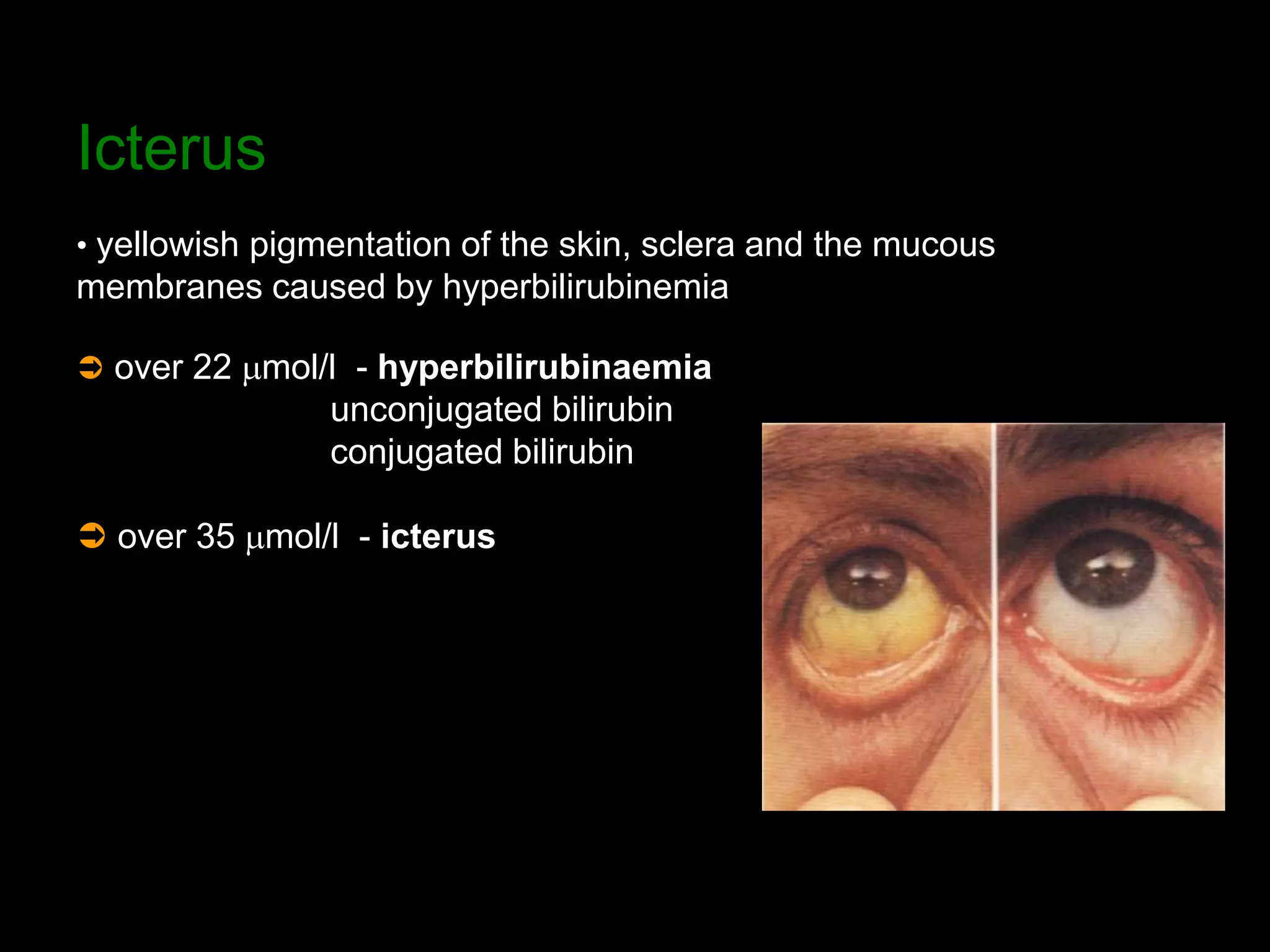 Icterus
• yellowish pigmentation of the skin, sclera and the mucous
membranes caused by hyperbilirubinemia
 over 22 mmol/l - hyperbilirubinaemia
unconjugated bilirubin
conjugated bilirubin
 over 35 mmol/l - icterus
 