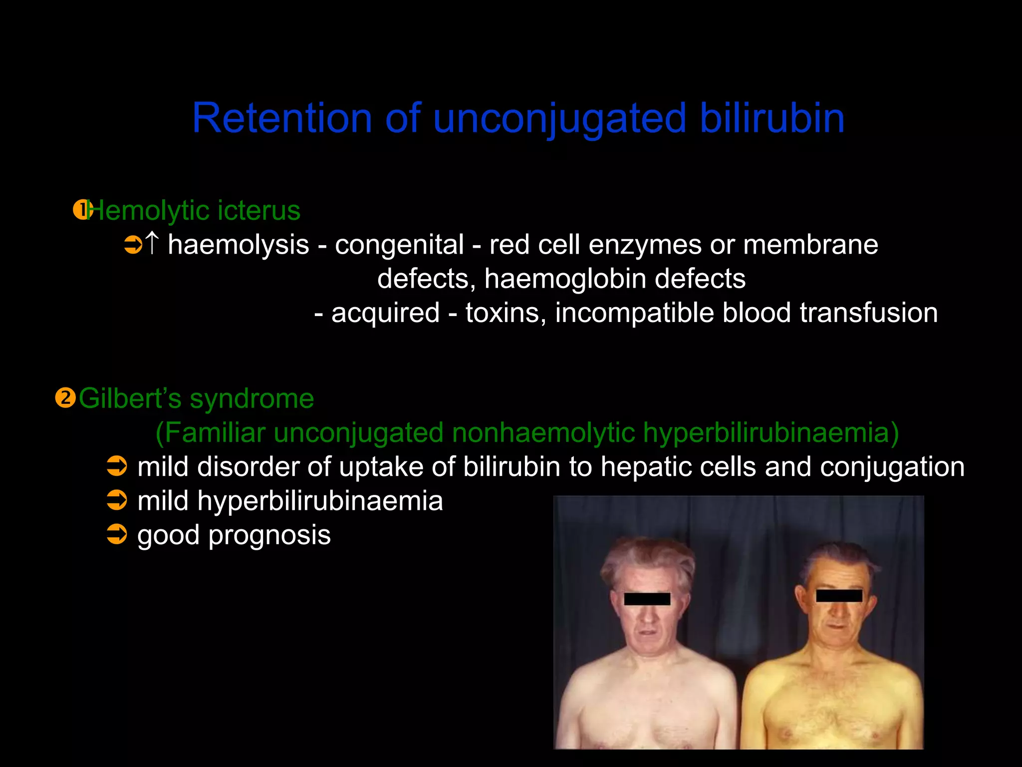 Retention of unconjugated bilirubin
Gilbert’s syndrome
(Familiar unconjugated nonhaemolytic hyperbilirubinaemia)
 mild disorder of uptake of bilirubin to hepatic cells and conjugation
 mild hyperbilirubinaemia
 good prognosis
Hemolytic icterus
 haemolysis - congenital - red cell enzymes or membrane
defects, haemoglobin defects
- acquired - toxins, incompatible blood transfusion
 