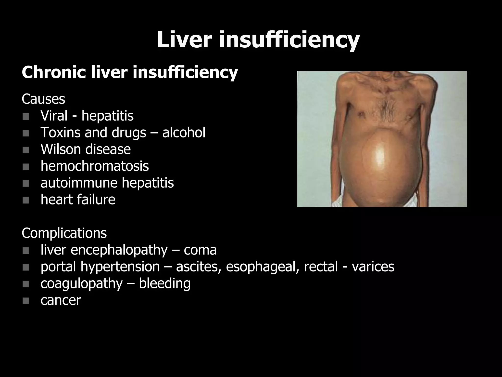 Chronic liver insufficiency
Causes
 Viral - hepatitis
 Toxins and drugs – alcohol
 Wilson disease
 hemochromatosis
 autoimmune hepatitis
 heart failure
Complications
 liver encephalopathy – coma
 portal hypertension – ascites, esophageal, rectal - varices
 coagulopathy – bleeding
 cancer
Liver insufficiency
 