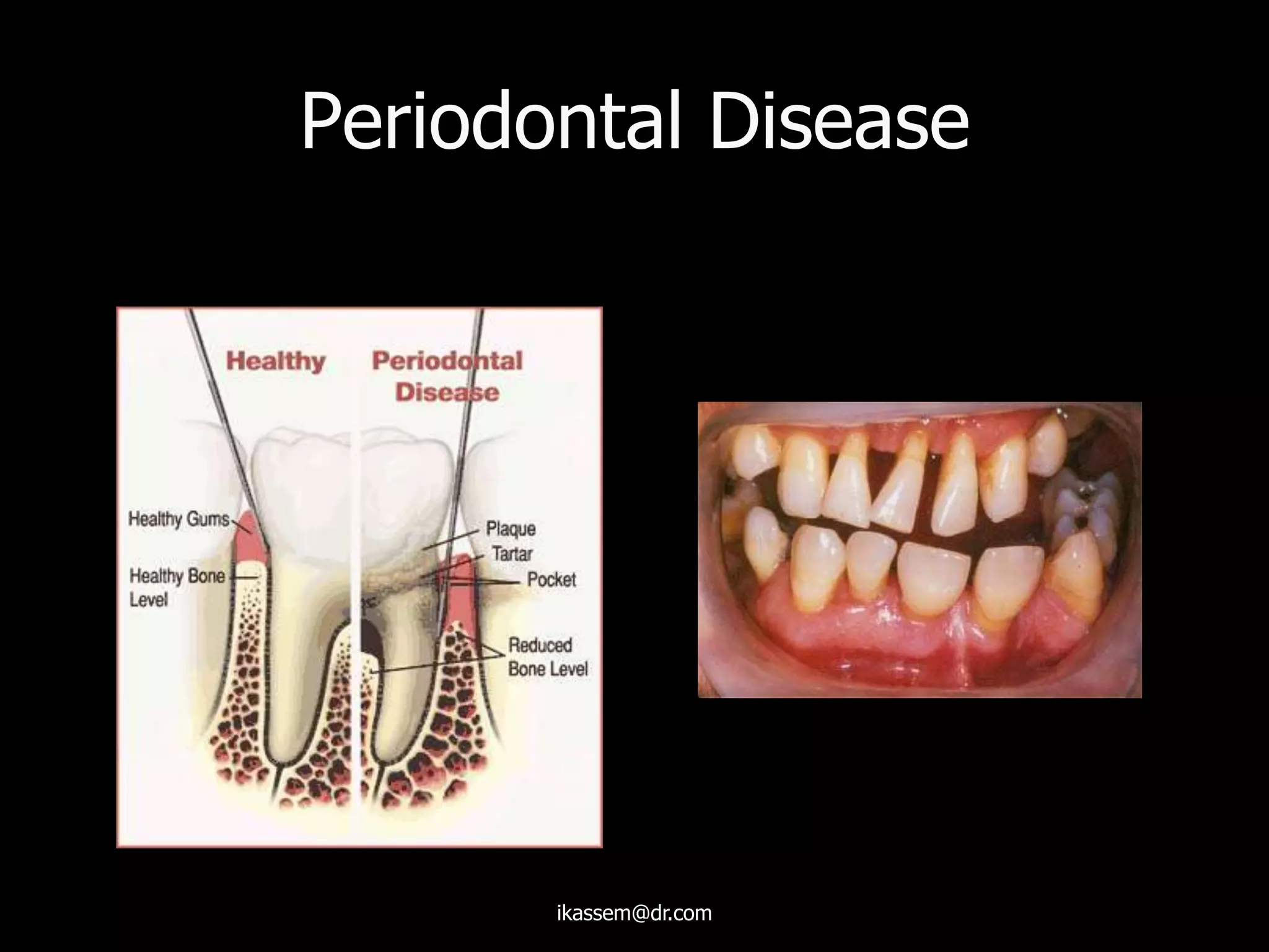 Periodontal Disease
ikassem@dr.com
 