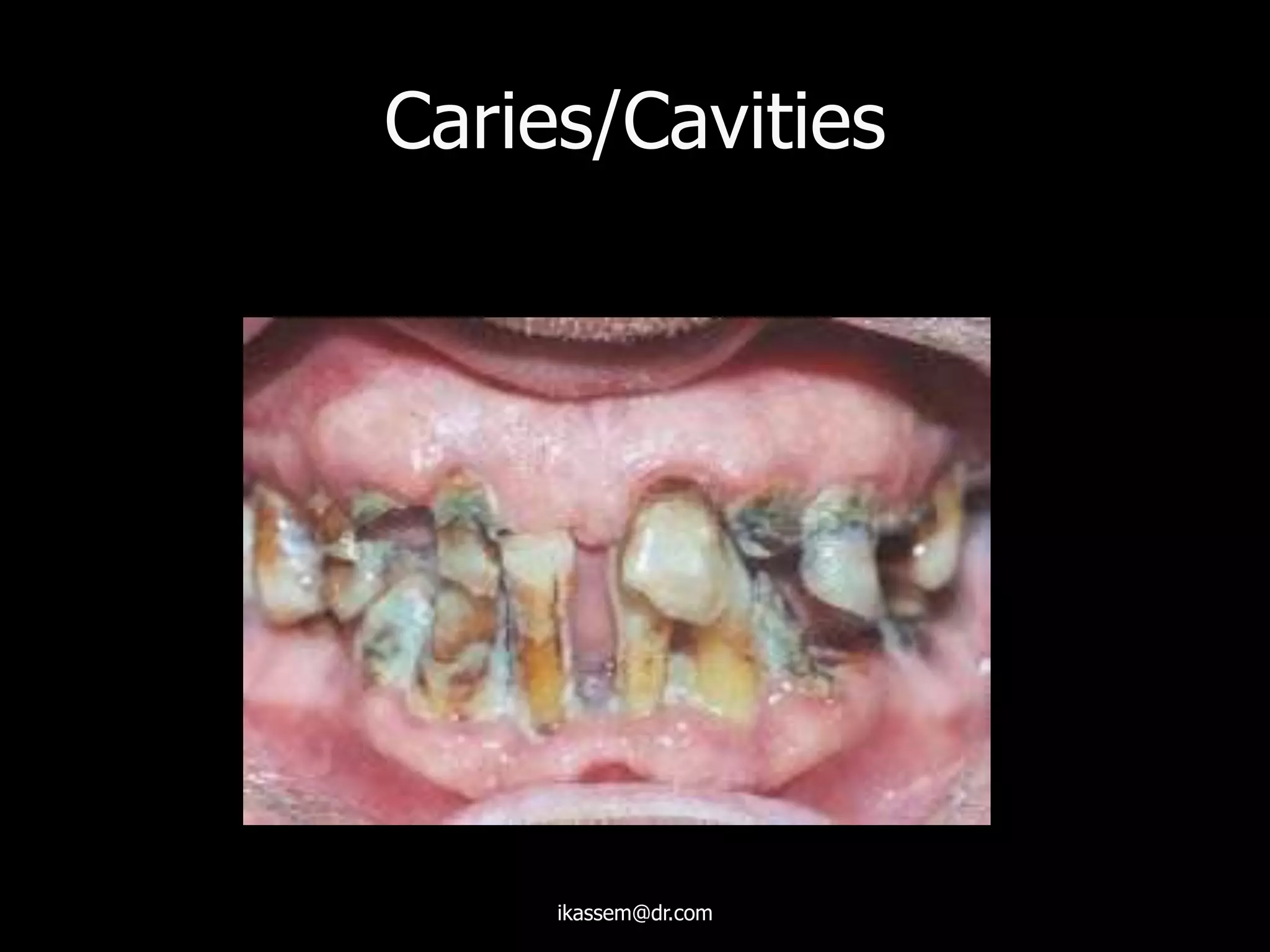 Caries/Cavities
ikassem@dr.com
 