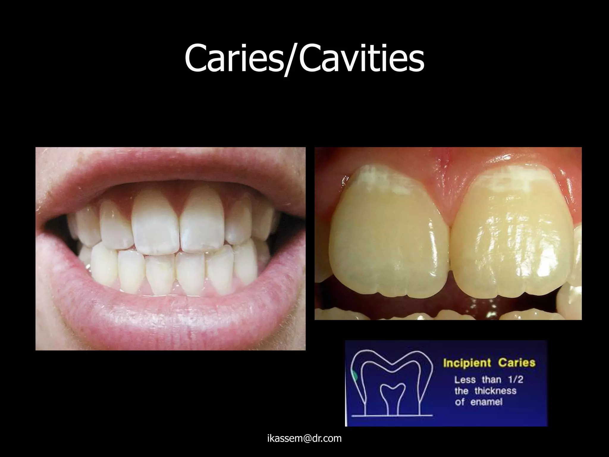Caries/Cavities
ikassem@dr.com
 