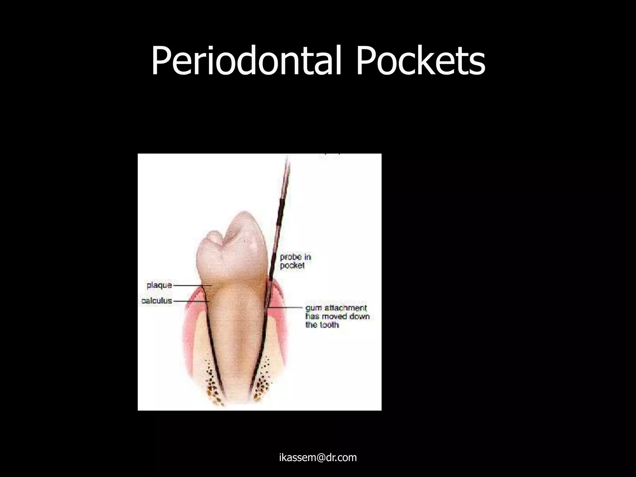 Periodontal Pockets
ikassem@dr.com
 