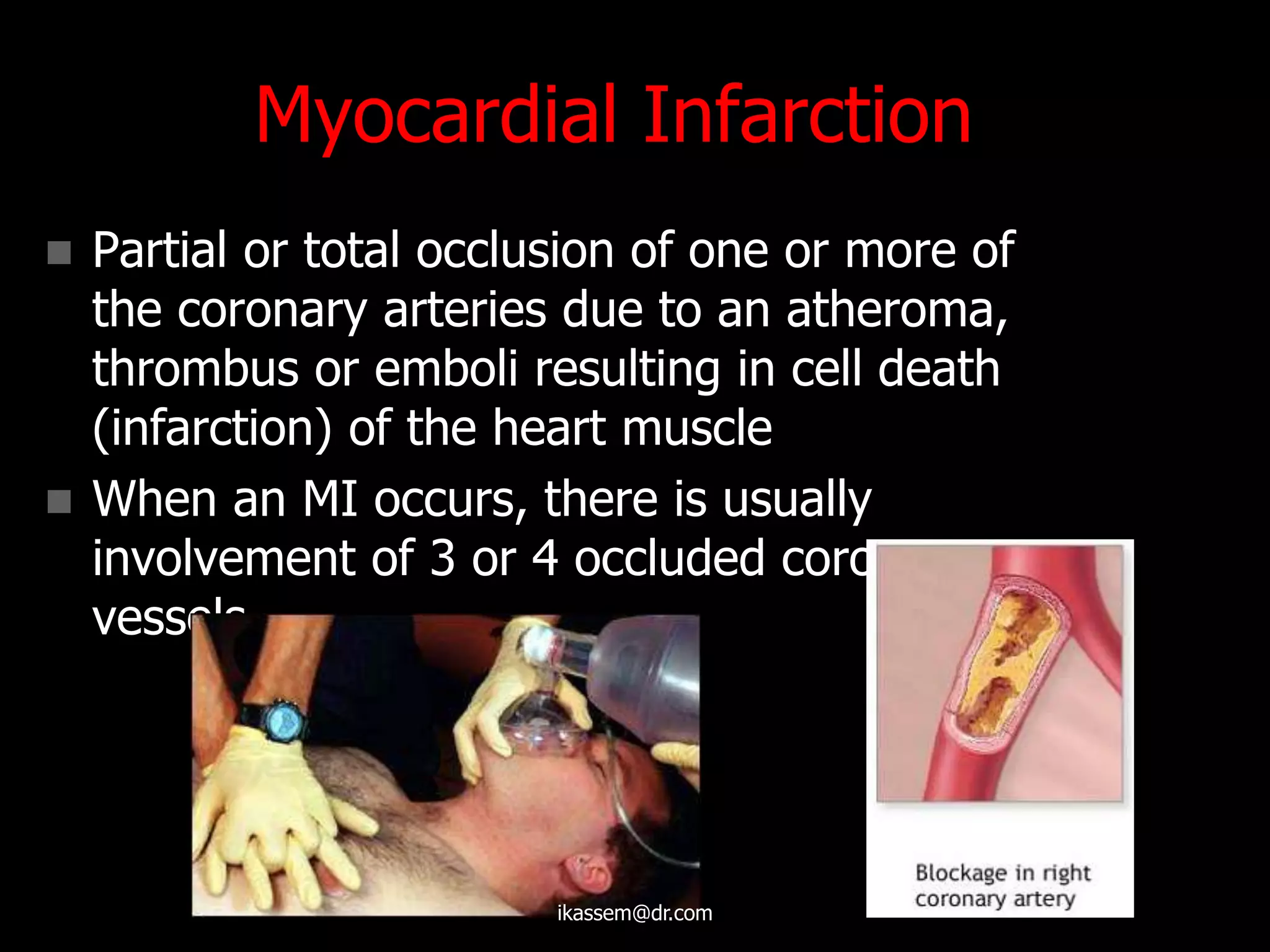 Myocardial Infarction
 Partial or total occlusion of one or more of
the coronary arteries due to an atheroma,
thrombus or emboli resulting in cell death
(infarction) of the heart muscle
 When an MI occurs, there is usually
involvement of 3 or 4 occluded coronary
vessels
ikassem@dr.com
 