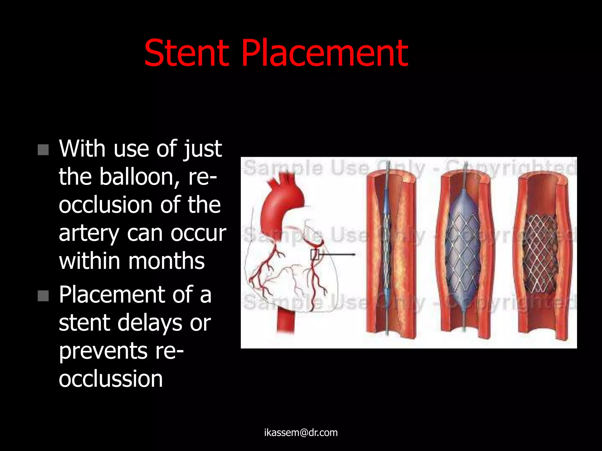 Stent Placement
 With use of just
the balloon, re-
occlusion of the
artery can occur
within months
 Placement of a
stent delays or
prevents re-
occlussion
ikassem@dr.com
 