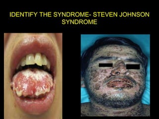 IDENTIFY THE SYNDROME- STEVEN JOHNSON
SYNDROME

 