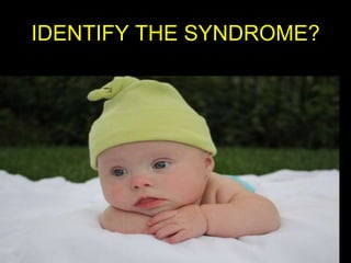 IDENTIFY THE SYNDROME?

 