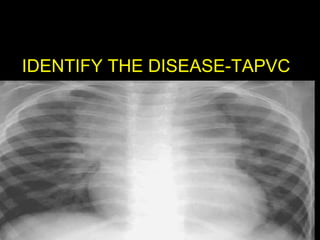 IDENTIFY THE DISEASE-TAPVC

 