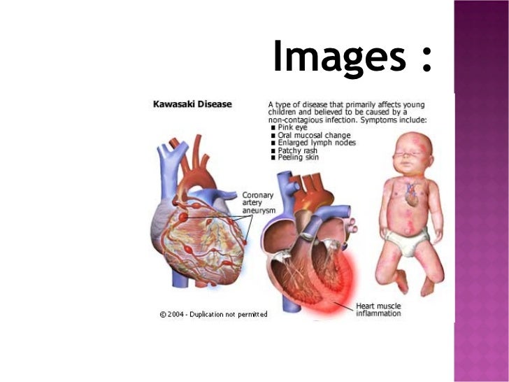 Medical research kawasaki disease