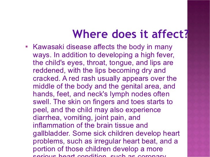 Does Kawasaki Disease Affect The Brain Does Kawasaki Disease Affect The Brain