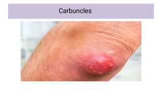 Carbuncle Radiopaedia MEDICAL SURGICAL NURSING 1-1.pdf