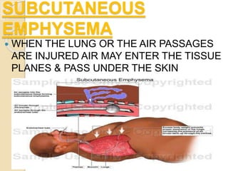 Medical surgical nursing ppt on chest injuries | PPTX