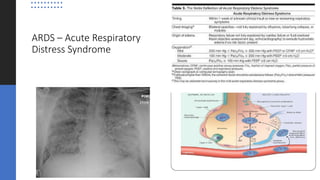ARDS – Acute Respiratory
Distress Syndrome
