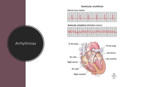Arrhythmias