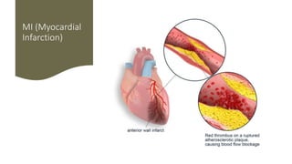 MI (Myocardial
Infarction)