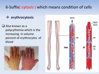 6-Suffix( cytosis ) which means condition of cells
 erythrocytosis
 Also known as a
polycythemia which is the
increasing in volume
percent of erythrocytes of
blood
 