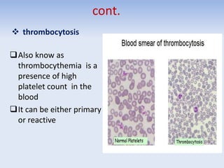 cont.
 thrombocytosis
Also know as
thrombocythemia is a
presence of high
platelet count in the
blood
It can be either primary
or reactive
 