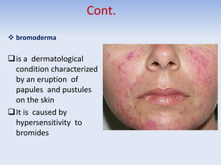Cont.
 bromoderma
is a dermatological
condition characterized
by an eruption of
papules and pustules
on the skin
It is caused by
hypersensitivity to
bromides
 